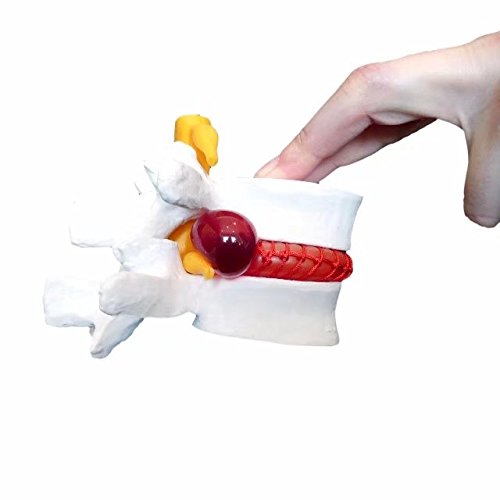 Mike-Dental Modello per prolasso del disco vertebrale con ernia lombare, anatomia umana medicale